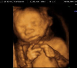 3d ultrasound images in New York, NY (Manhattan)
