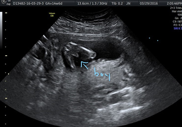 2D ultrasound image baby male