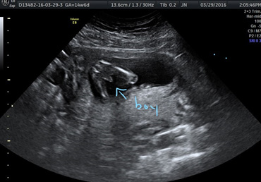 Gender reveal scan Gender Reveal