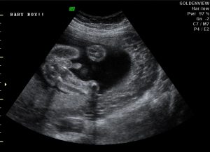 2D ultrasound baby male