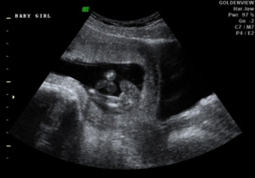 2D ultrasound image baby female