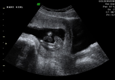 define sonogram define sonogram