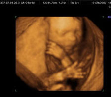 3d-ultrasound-21weeks