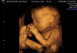 Goldenview Ultrasound 3D image