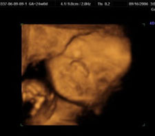 3d-ultrasound-24weeks