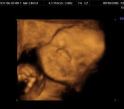 3d ultrasound 24 weeks
