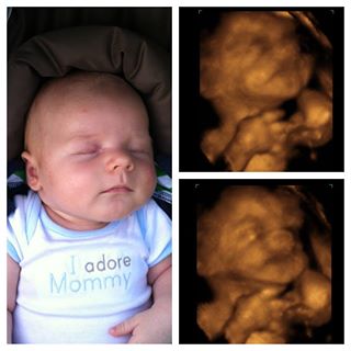 3D Ultrasound - HD ultrasound in Chicago