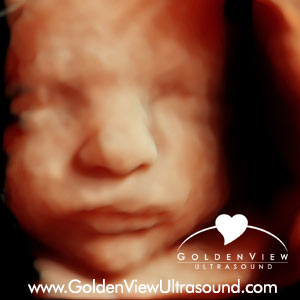goldenview-HDlive-ultrasound-27-weeks