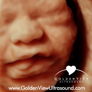 goldenview-HDlive-ultrasound-31-weeks
