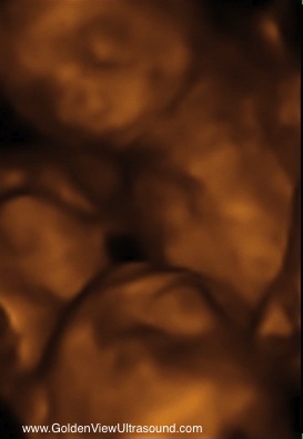 twins 23 weeks goldenview ultrasound SanAntonio